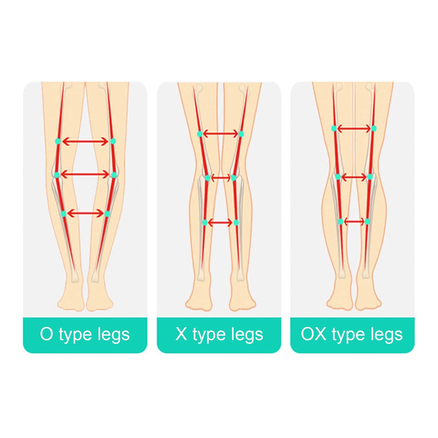 Leg Corrector Strap, O X Type Leg Correction Bandage, O X Legs Correction Belt Legs Posture Corrector Band for Adults (L)